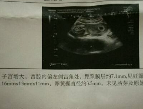 检查发现是宫角妊娠