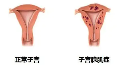 子宫腺肌症能怀孕吗.png