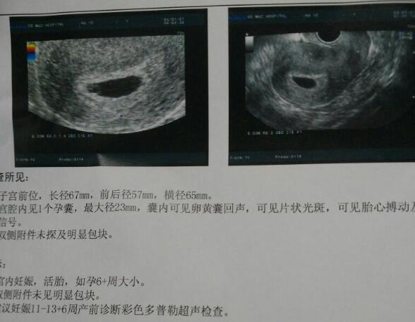 双胎变单胎可能是质量引起