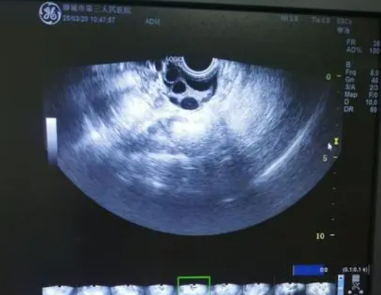 右侧有一个优势卵泡是正常是