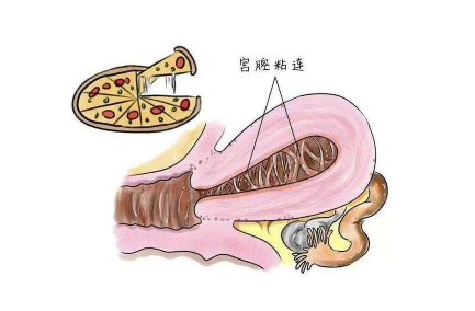 宫颈粘连是什么引起的，怎么不知不觉间就得了？