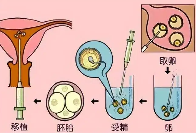 供卵选性别.png