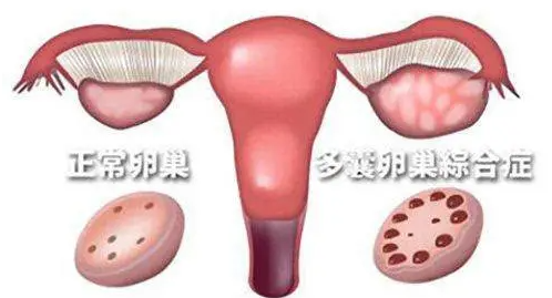 多囊卵巢综合症怎么调理好的快.png