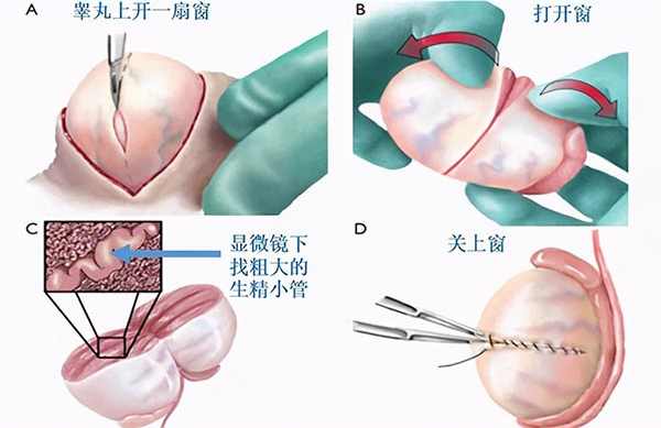 二代试管不只用穿刺取精